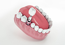 	Имплантация жевательных зубов