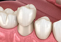 Восстановленление коронки зуба