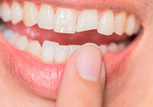 Реставрация твердых тканей зуба