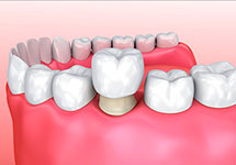 Реставрация жевательных зубов