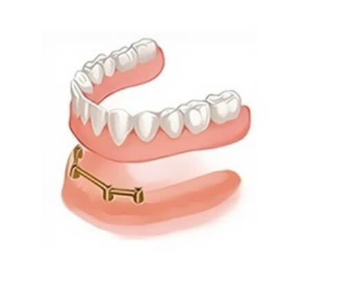 Протезирование зубов на 4 имплантах