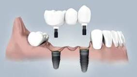 Имплантация жевательных зубови
