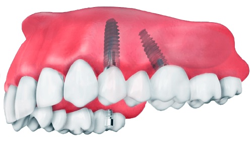 Имплантация передних зубов