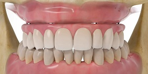 Имплантация зубов под ключ